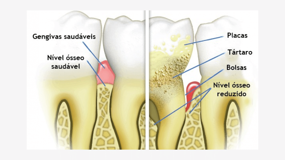 A doença periodontal e seu tratamento